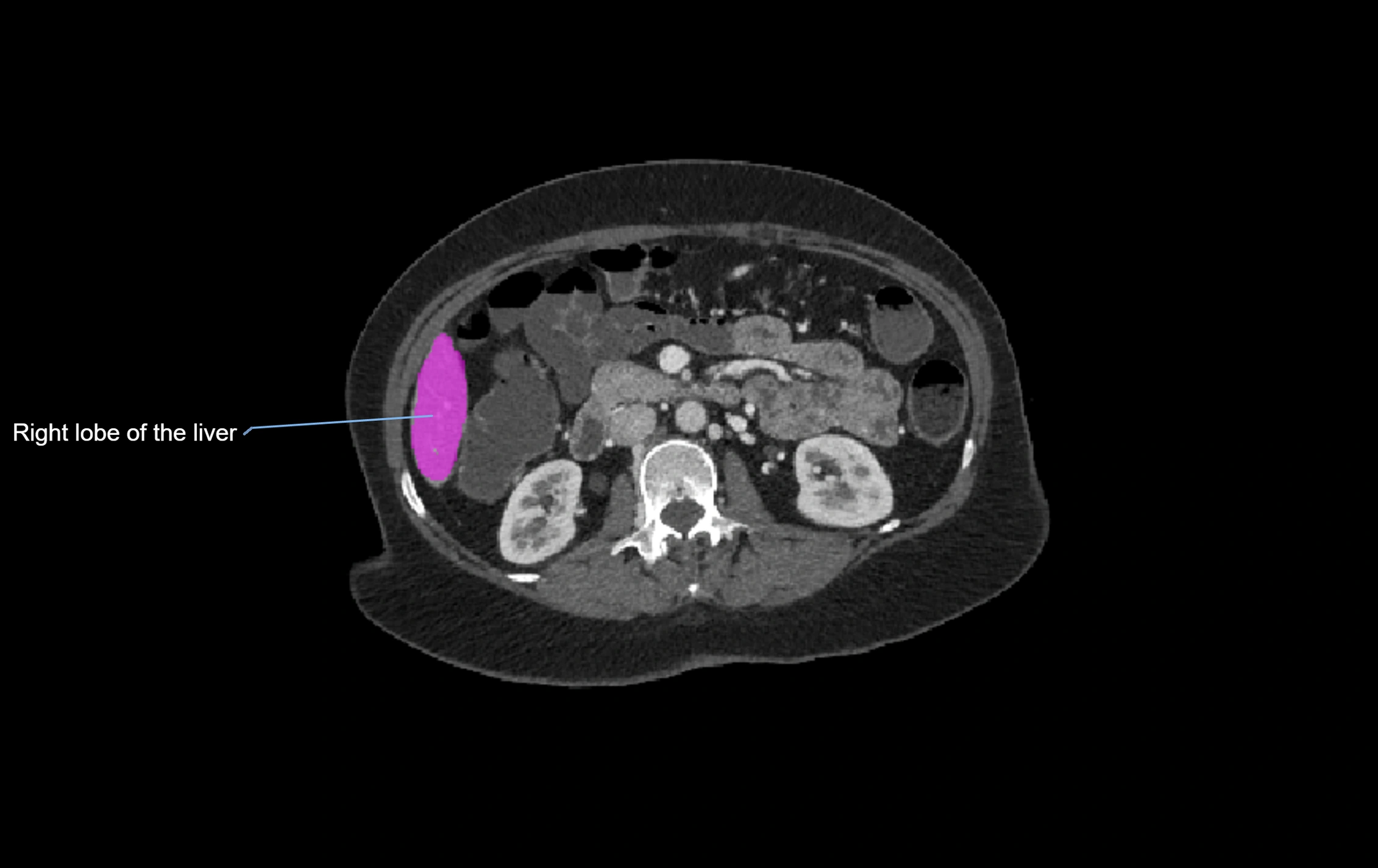 CT lliver lobes axial cross sectional anatomy labelled image -00013.webp